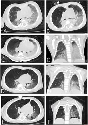 Case Report: Clinical manifestations and treatment of two Chinese patients with FINCA syndrome carrying a novel variant of NHLRC2